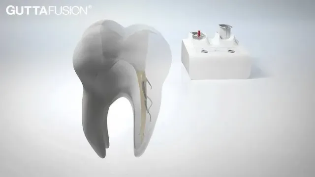 Maschinelle Wurzelbehandlung (Endodontie)